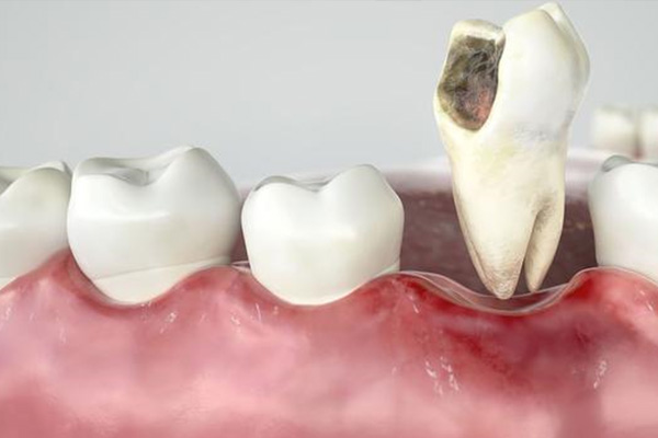 牙体缺损修复多少钱一颗牙(牙体缺损修复多少钱一颗牙套)