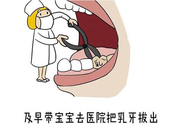 乳牙滞留为什么要及时拔除呢载(为什么出现乳牙滞留)
