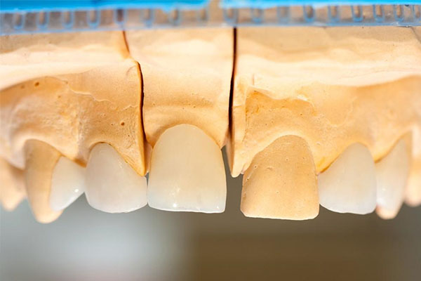 牙冠卸下来还能用吗(牙冠卸下来还能用吗多少钱)