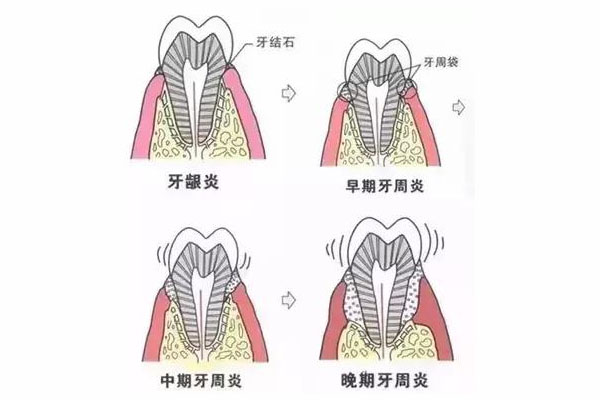 牙周发炎肿痛(牙周发炎肿痛怎么消炎最快吃什么药)