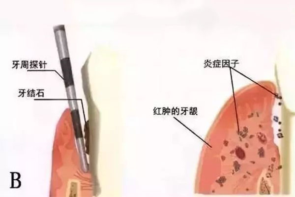 根管治疗一共需要去几次医院(根管治疗一共需要去几次医院呢