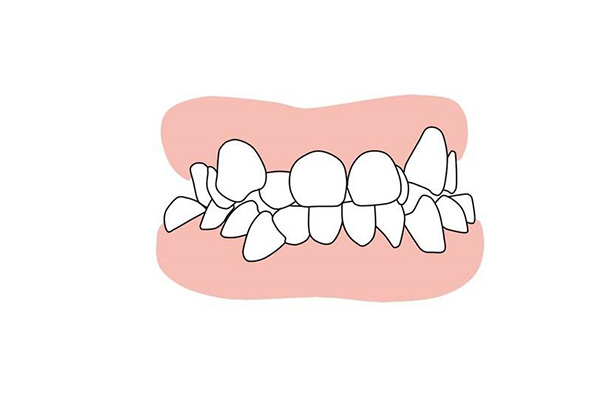 牙齿不齐可不可以做烤瓷牙矫正呢(牙齿不齐可不可以做烤瓷牙矫