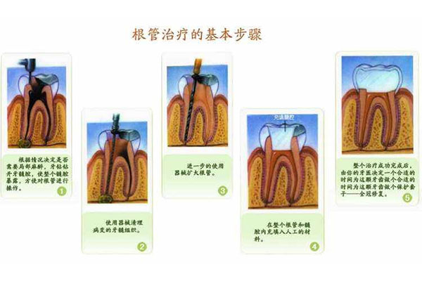 一颗牙根管治疗6000块贵不贵(一颗牙根管治疗6000块贵不贵呢)