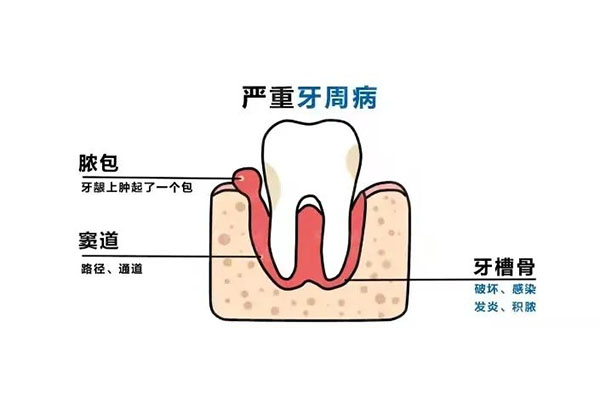 严重牙周炎用什么药治疗(严重牙周炎用什么药治疗好)