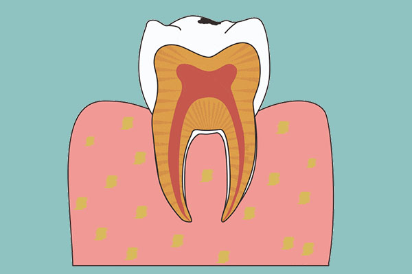 乳牙滞留 双排牙(乳牙滞留双排牙拔后归位吗)