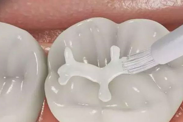 小孩儿牙齿涂氟多少钱(小孩儿牙齿涂
