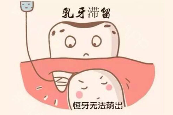 乳牙滞留双排牙(乳牙滞留双排牙拔后