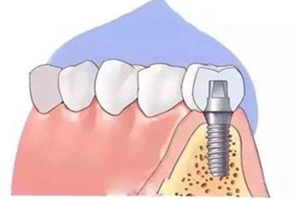 70岁以上的老人可以种牙吗多少钱(70岁以上的老人可以种牙吗多少钱一棵)
