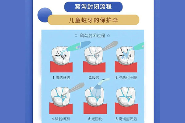 孩子的牙齿需要涂氟吗(孩子的牙齿需