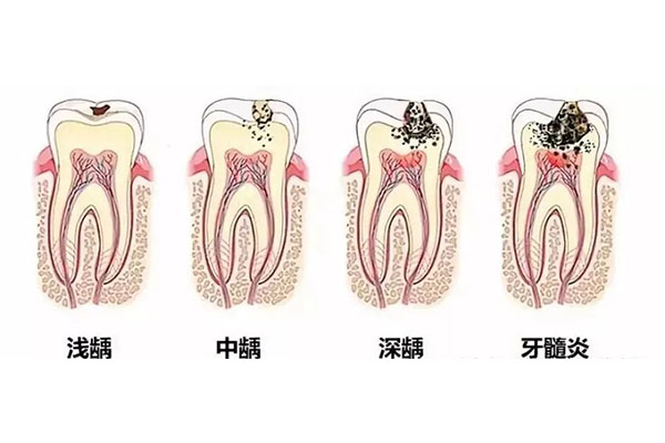 儿童牙髓炎吃什么药消炎止痛最好(儿