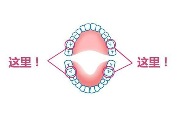 8岁孩子六龄牙一点点龋齿要补吗多少