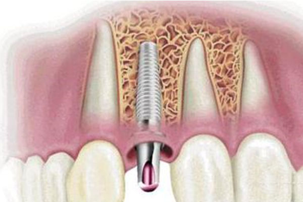 70岁以上的老人适合种牙吗为什么(70岁以上的老人适合种牙吗为什么不能种)