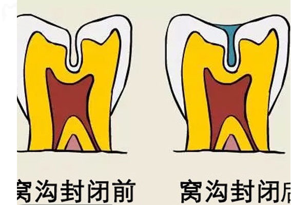 小孩涂氟一次要多少钱左右(小孩子涂