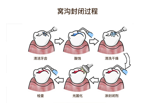 怎么给牙齿涂氟(怎么给牙齿涂氟自己