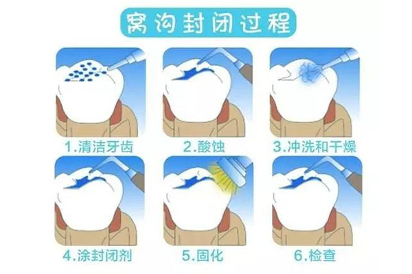儿童涂氟的作用有哪些方面(儿童涂氟