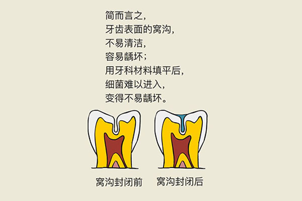 成人牙齿脱矿涂氟有用吗(成人牙齿脱矿涂氟有用吗多少钱)