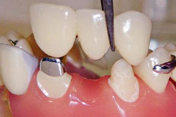 一个烤瓷牙要多少钱一颗及价格(一个烤瓷牙做下来大概多少钱烤瓷牙的价格)