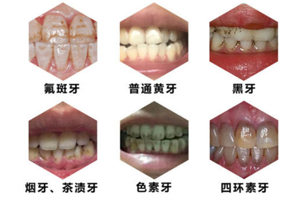 什么叫色素回流症和症状(什么叫色素回流症和症状图片)
