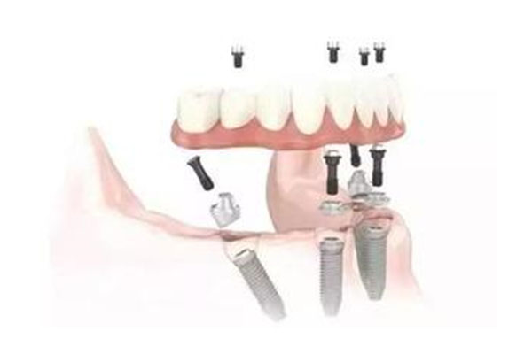 13岁的孩子矫正牙齿建议用哪种牙套矫正(13岁的孩子矫正牙齿建议用哪种牙套矫