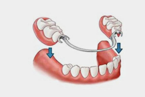 一般烤瓷牙粘上去管多久(一般烤瓷牙粘上去管多久能好)