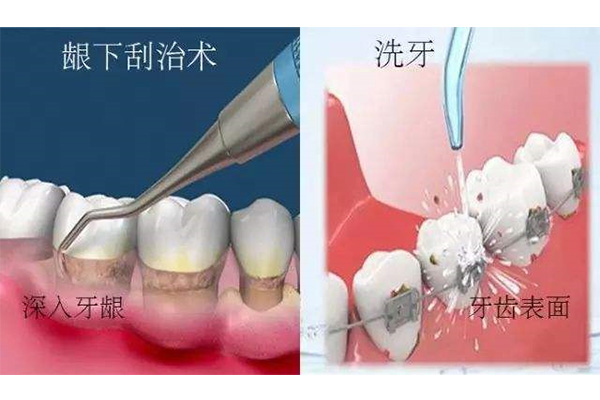 一岁宝宝牙齿钙化是什么原因引起的