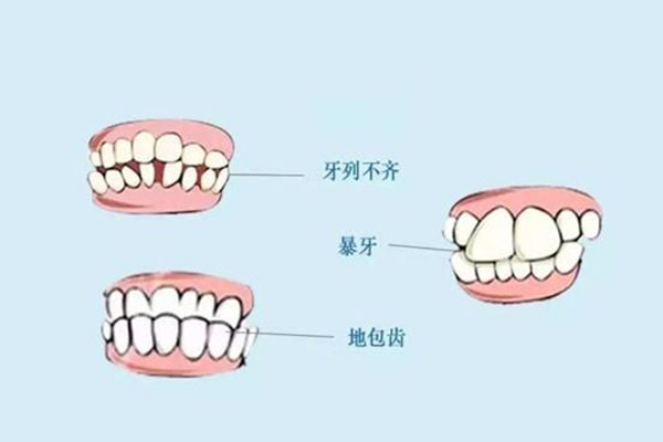 20岁做地包天矫正术有效果吗多少钱