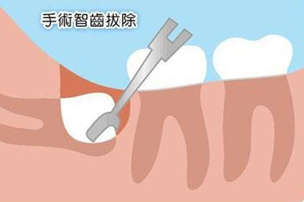 上颌智齿在哪(上颌智齿在哪个位置图片)