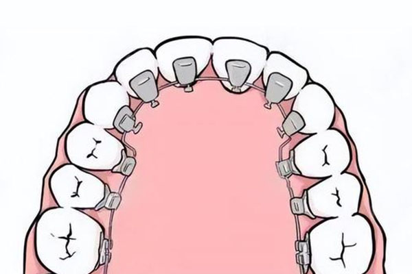儿童牙齿排列拥挤,有做早期矫正的必要吗(儿童牙齿排列拥挤,有