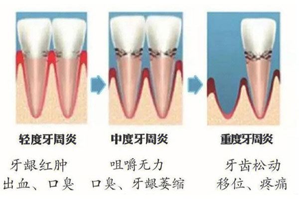 中医治牙周炎偏方秘方治疗(中医治牙