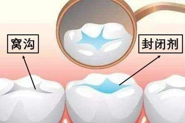 儿童牙齿涂氟好处(儿童牙齿涂氟有什么好处和坏处)