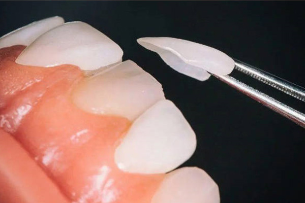 做了牙齿贴面后为什么会牙痛的厉害(做完牙齿贴面后牙齿酸痛怎么办)