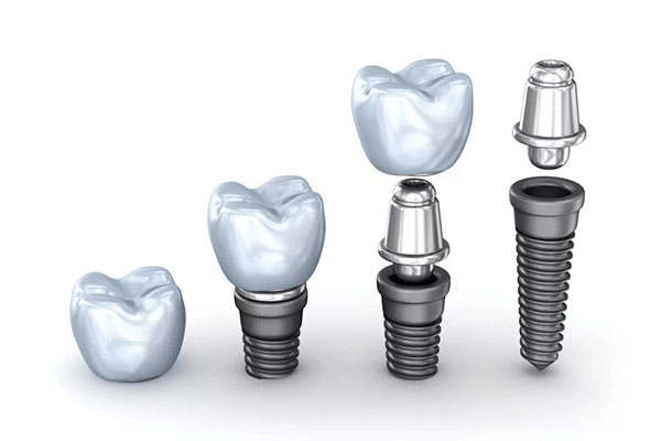 70岁以上老人种牙有什么条件要求(70岁以上老人种牙有什么条件要求吗视频)