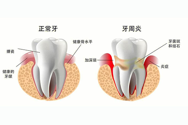 严重牙周炎需要治疗多久才能治好呀