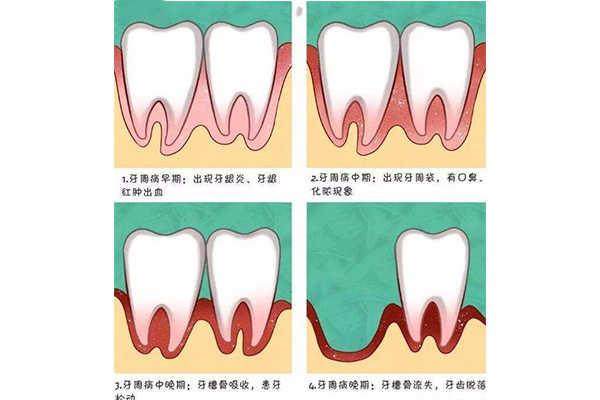 严重牙周病怎么治疗效果好一点(严重牙周病怎么治疗效果好一点