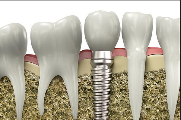 50岁种植牙齿好不好呢(50岁种植牙齿好不好呢图片)
