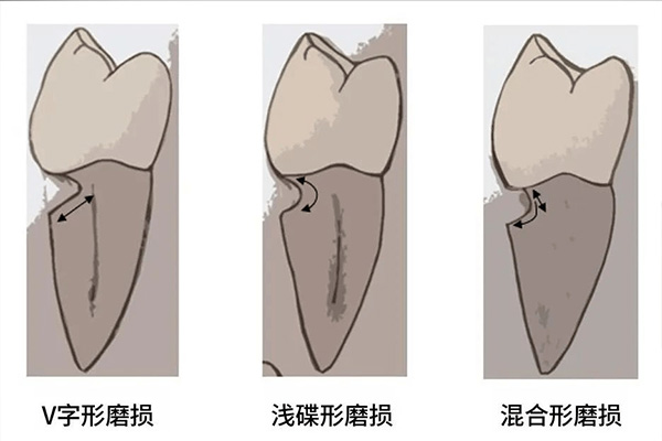 什么是牙列缺损牙列缺损的修复方法有哪些呢