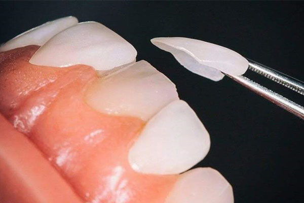 义获嘉全瓷牙贴面(义获嘉全瓷牙贴面怎么样)