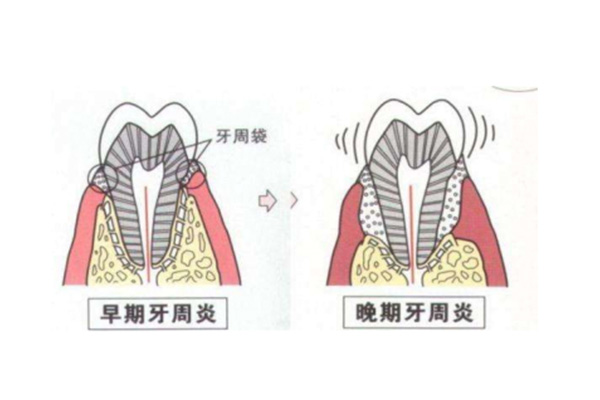 严重牙周炎症状(严重牙周炎症状表现)