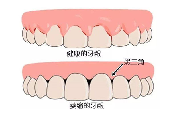 30岁牙龈萎缩正常吗怎么治疗好得快呢(30岁牙龈萎缩正常吗怎么