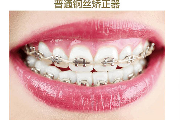 12岁牙齿矫正费用怀化(12岁的孩子矫正