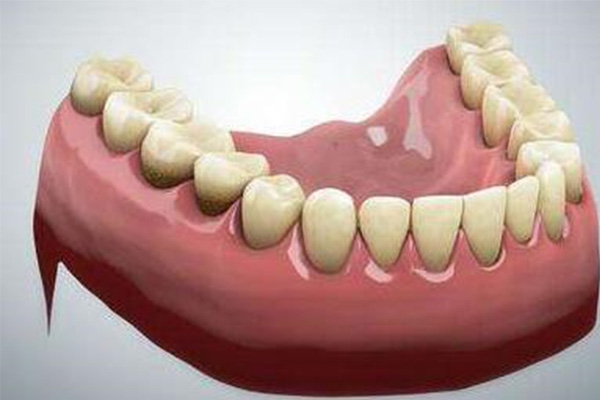 一个义齿两个套稳固吗多少钱一副(一颗义齿)