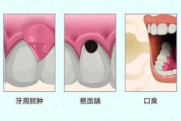 严重的牙周炎症状(严重的牙周炎症状图片)