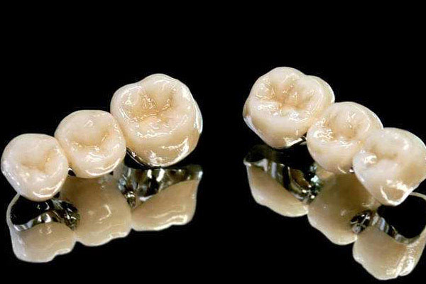 300元1颗的烤瓷牙 价格(300一颗的烤瓷牙)