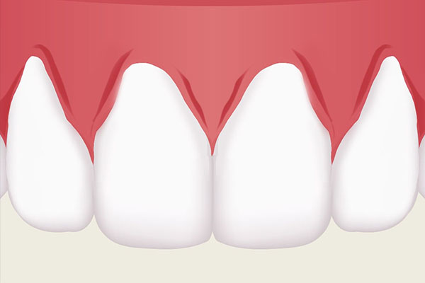 35岁牙龈萎缩牙根外露怎么治疗最好的方法(35岁牙龈萎缩牙根外露怎么治疗最好