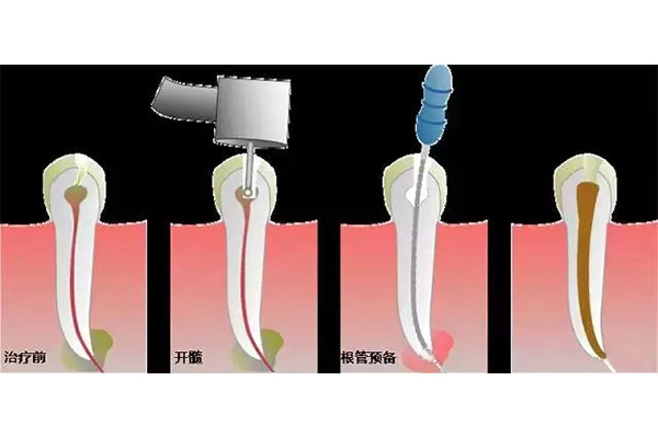 三甲医院根管治疗要多少钱(三甲医院根管治疗要多少钱一次)