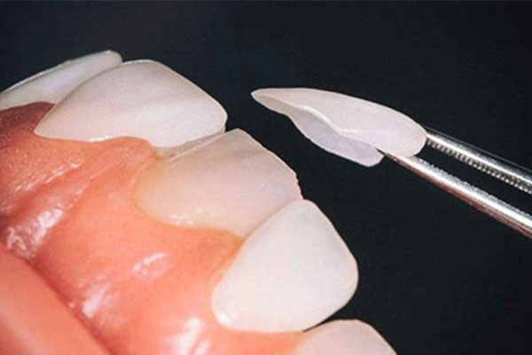 义获嘉铸瓷贴面的成分(义获嘉铸瓷贴面多少钱)