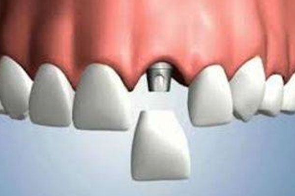 2021年种牙走医保吗能报销吗(2021年种牙走医保吗能报销吗北京)