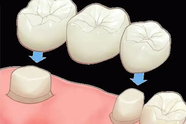 700元的全瓷牙好吗(700元的全瓷牙好吗多少钱)