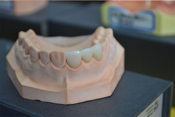 三颗活动义齿多少钱(三颗活动义齿多少钱一个)