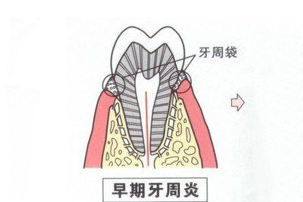 严重性牙周炎(严重性牙周炎怎么治疗)